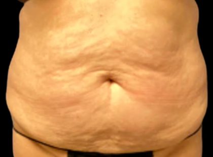 Tummy Tuck Before & After Patient #6014