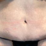 Tummy Tuck Before & After Patient #6014