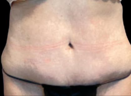 Tummy Tuck Before & After Patient #6014