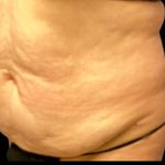 Tummy Tuck Before & After Patient #6014