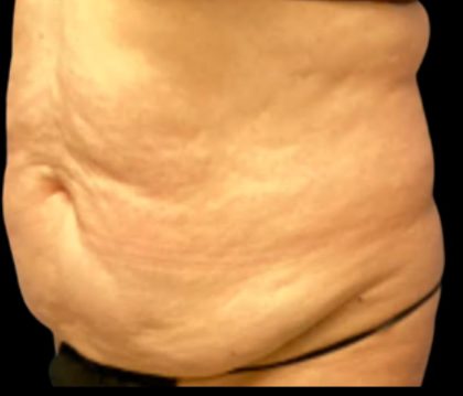 Tummy Tuck Before & After Patient #6014