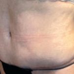 Tummy Tuck Before & After Patient #6014