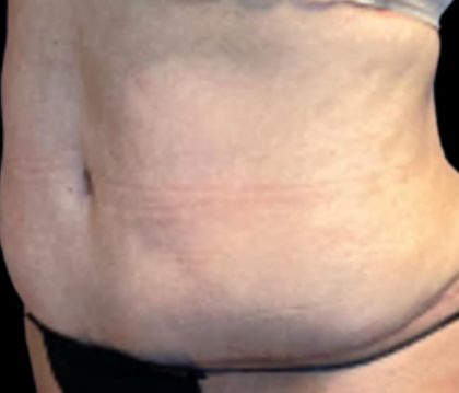 Tummy Tuck Before & After Patient #6014