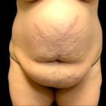 Tummy Tuck Before & After Patient #6013