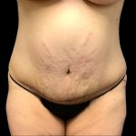 Tummy Tuck Before & After Patient #6013