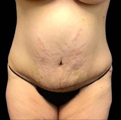 Tummy Tuck Before & After Patient #6013