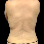Tummy Tuck Before & After Patient #6013