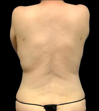 Tummy Tuck Before & After Patient #6013