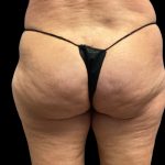 Aveli Before & After Patient #6086
