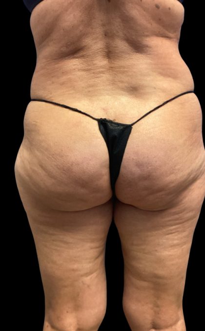 Aveli Before & After Patient #6086