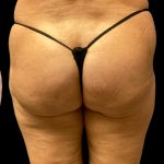 Aveli Before & After Patient #6086