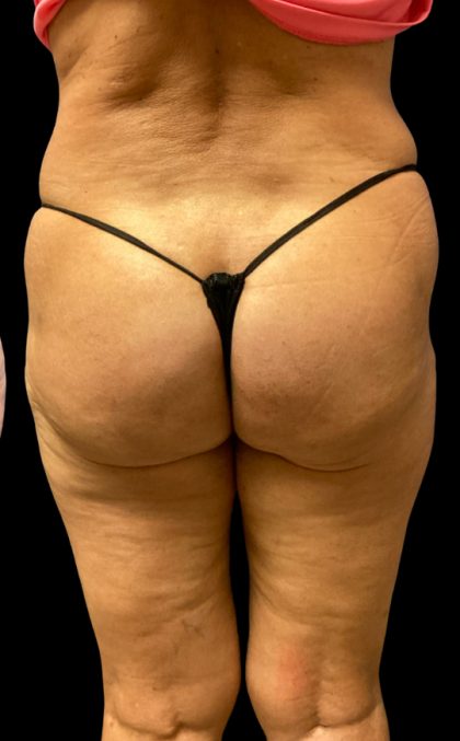 Aveli Before & After Patient #6086