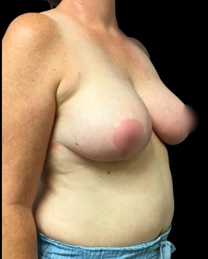 Breast Reduction Before & After Patient #5848