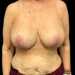 Breast Reduction Before & After Patient #6009