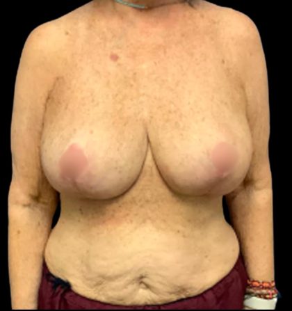 Breast Reduction Before & After Patient #6009