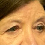 Blepharoplasty Before & After Patient #5849