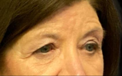 Blepharoplasty Before & After Patient #5849