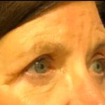 Blepharoplasty Before & After Patient #5849