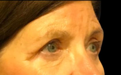 Blepharoplasty Before & After Patient #5849