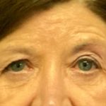 Blepharoplasty Before & After Patient #5849