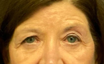 Blepharoplasty Before & After Patient #5849