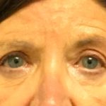 Blepharoplasty Before & After Patient #5849