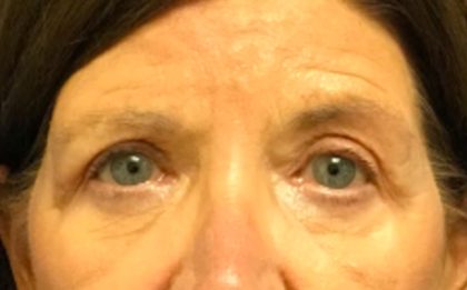 Blepharoplasty Before & After Patient #5849