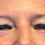 Blepharoplasty Before & After Patient #6008