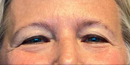 Blepharoplasty Before & After Patient #6008