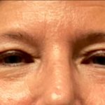 Blepharoplasty Before & After Patient #6008