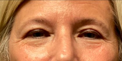 Blepharoplasty Before & After Patient #6008