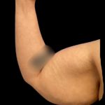 Arm Lift Before & After Patient #6007