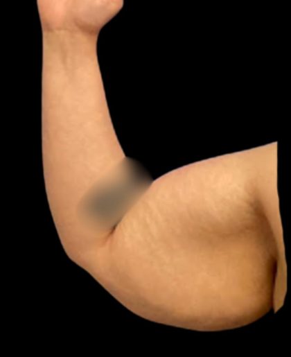 Arm Lift Before & After Patient #6007
