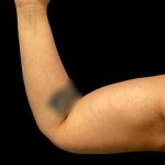 Arm Lift Before & After Patient #6007