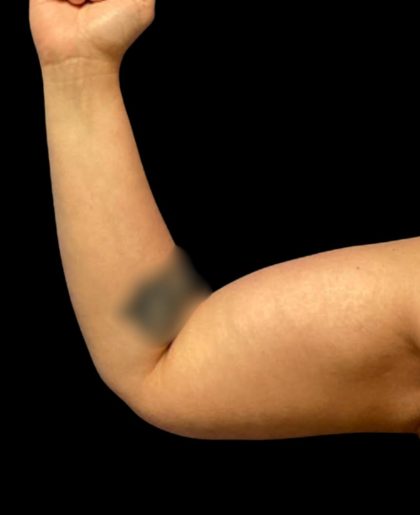 Arm Lift Before & After Patient #6007