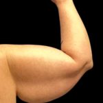 Arm Lift Before & After Patient #6007