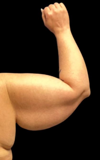 Arm Lift Before & After Patient #6007