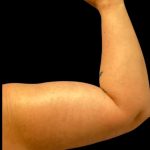 Arm Lift Before & After Patient #6007