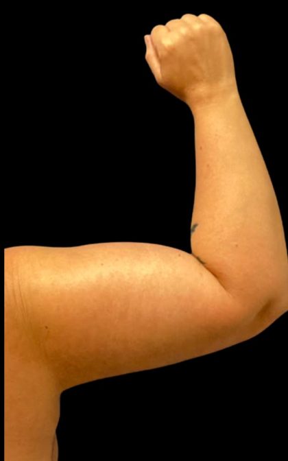 Arm Lift Before & After Patient #6007