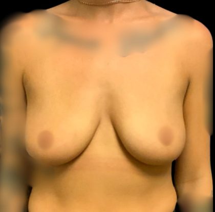 Breast Augmentation Before & After Patient #6006