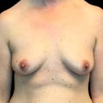 Breast Augmentation Before & After Patient #6005