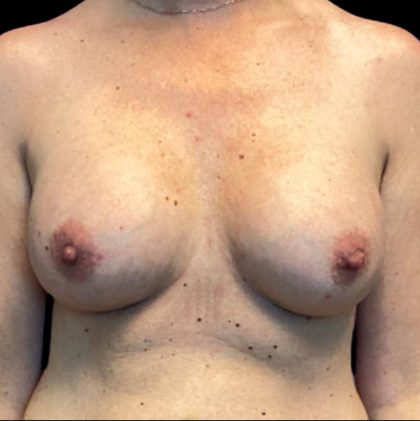 Breast Augmentation Before & After Patient #6005