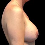 Breast Augmentation Before & After Patient #6005