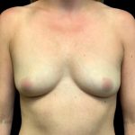 Breast Augmentation Before & After Patient #6087