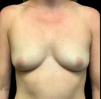 Breast Augmentation Before & After Patient #6087