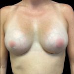 Breast Augmentation Before & After Patient #6087