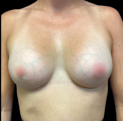 Breast Augmentation Before & After Patient #6087