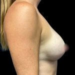 Breast Augmentation Before & After Patient #6087