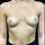 Breast Augmentation Before & After Patient #6088