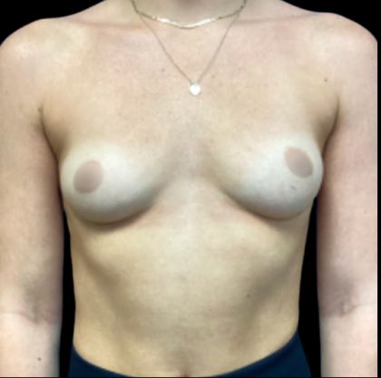 Breast Augmentation Before & After Patient #6088